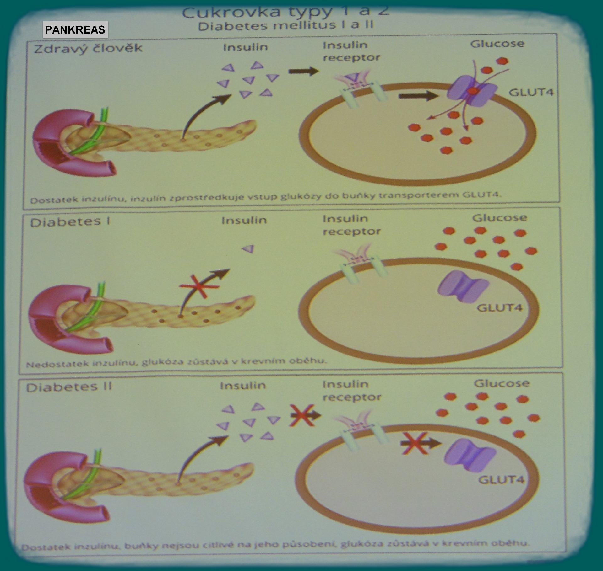 Diabetes melliltus